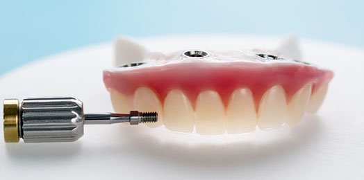 All-On-4 Dental Implants in Melbourne CBD