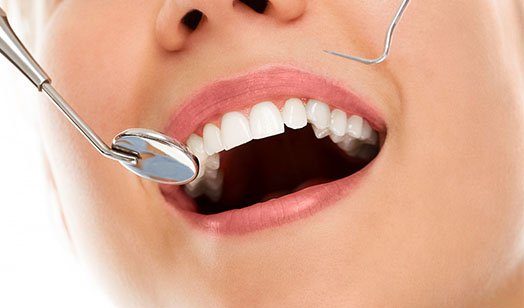 Dental Fillings Melbourne CBD