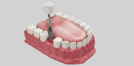 Dental Implants Melbourne CBD