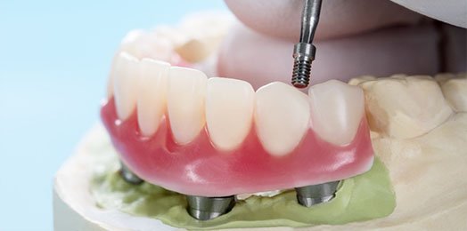 Mini Dental Implants in Melbourne CBD