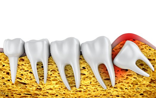 Wisdom Teeth Removal Melbourne CBD