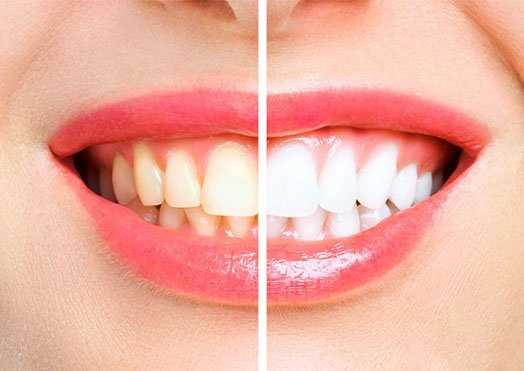 Teeth Whitening Melbourne CBD