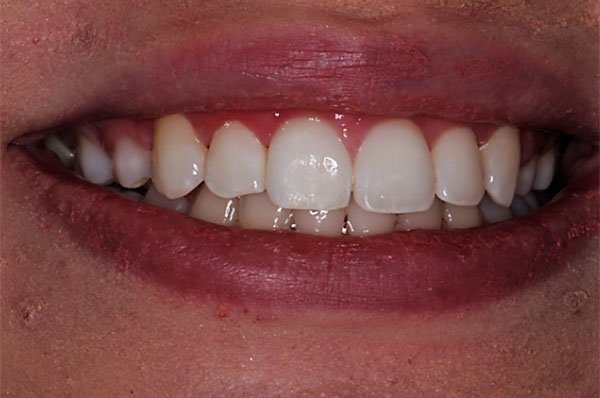 Fluorosis Case 1