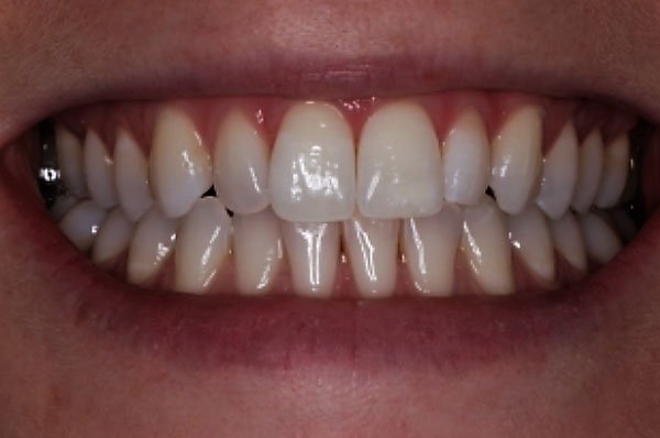 Fluorosis Case 2