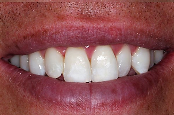 Fluorosis Case 3