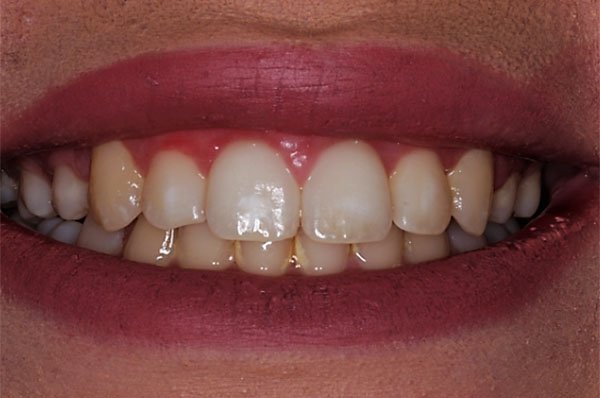 Fluorosis Case 1