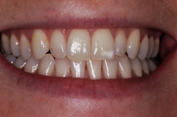 Fluorosis Case 2