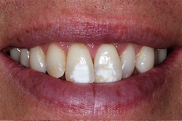 Fluorosis Case 3