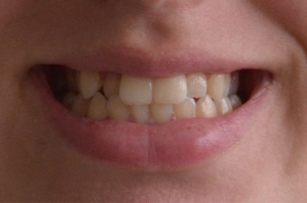 Invisalign Case 1