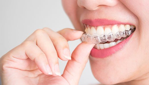 invisalign smileview melbourne cbd