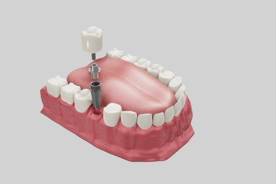 dental implants blurb melbourne cbd