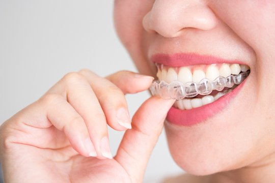 invisalign blurb melbourne cbd