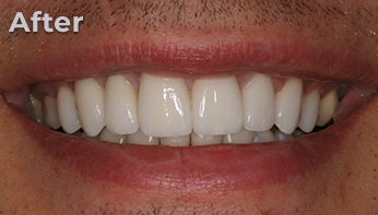 porcelain venners after case 2