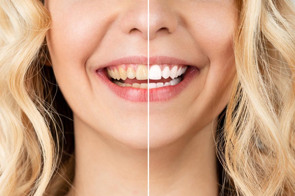 to 6 reasons why you should undergo teeth whitening