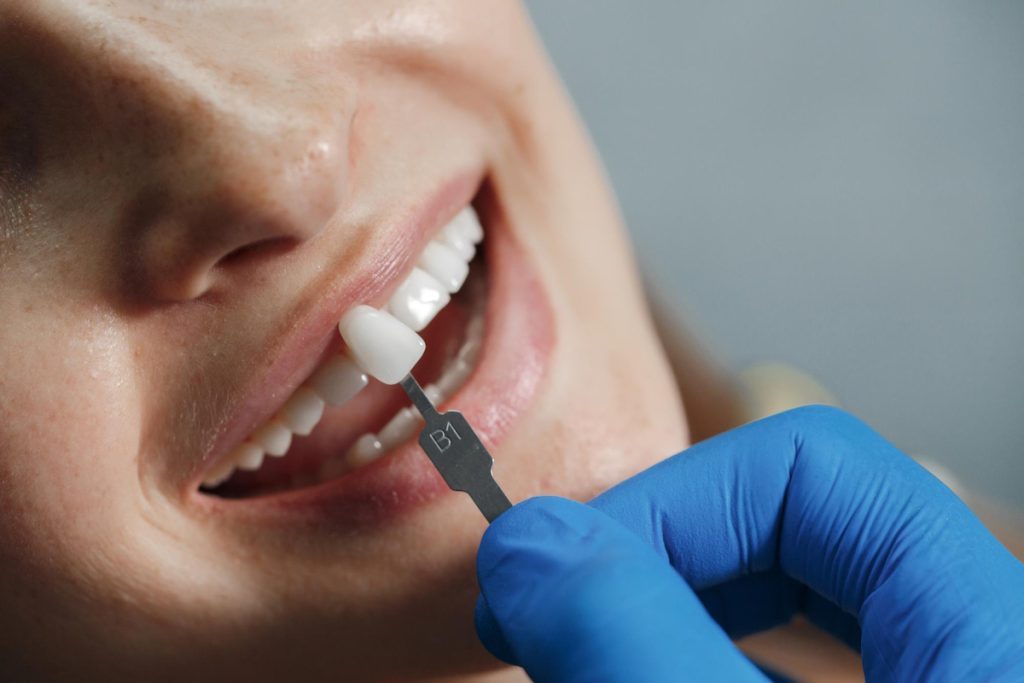 transform your smile with dental veneers