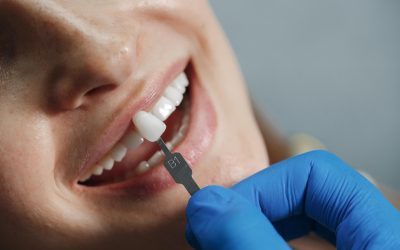 Transform Your Smile with Dental Veneers: What You Need to Know Before Getting Them