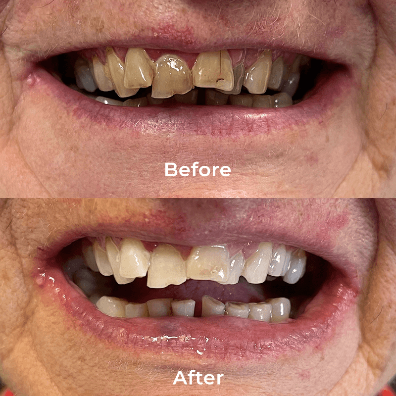 teeth whiteninge before and after dentist melbourne cbd