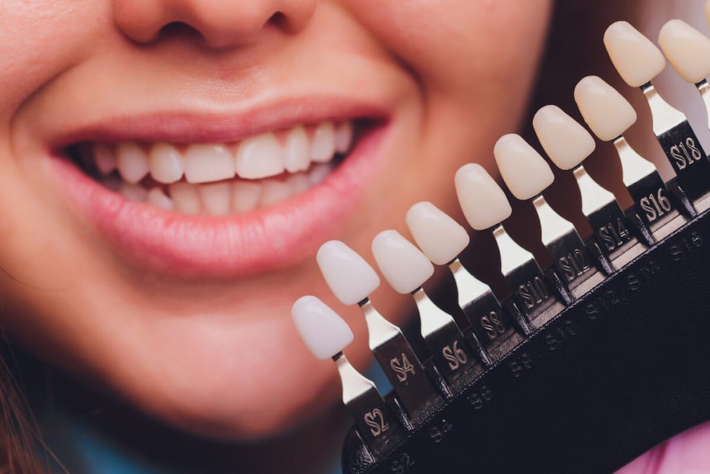 what do i need to know before getting dental veneers