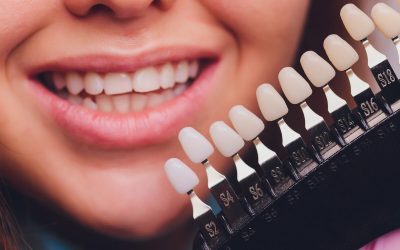 What Do I Need to Know Before Getting Dental Veneers?