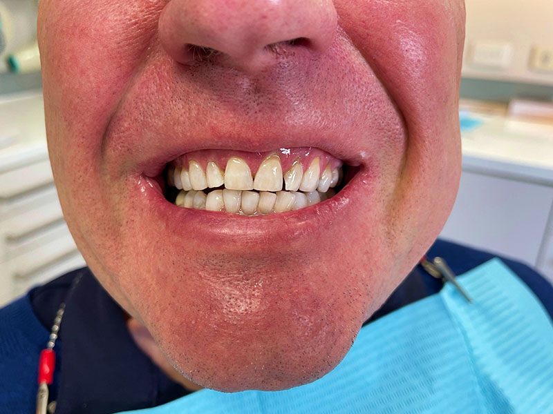 alister lindsay after teeth whitening dentist melbourne cbd
