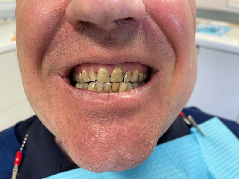 alister lindsay before teeth whitening dentist melbourne cbd