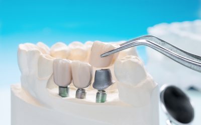 Why Bone Grafting is Crucial for a Successful Dental Implant Procedure