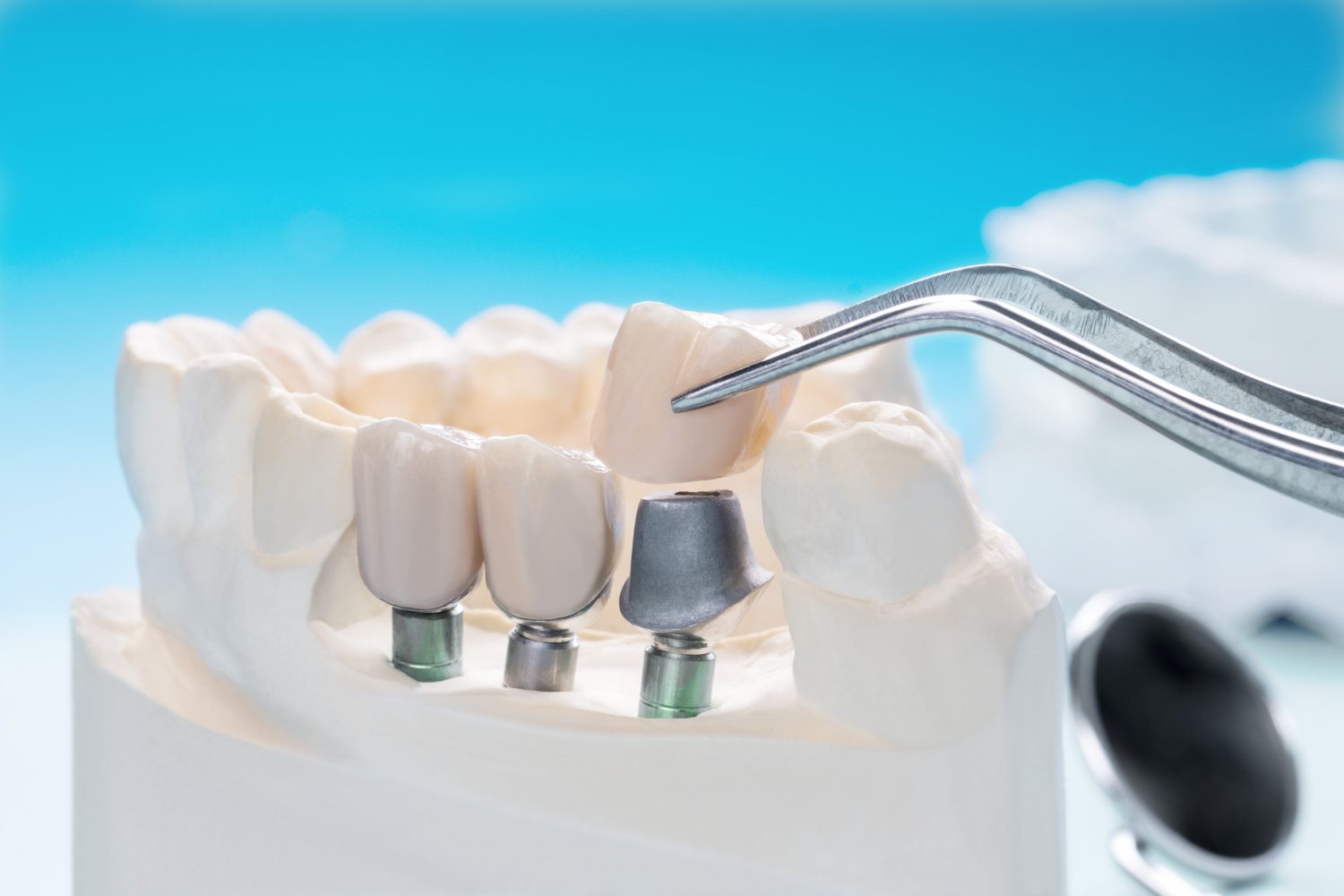 why bone grafting is crucial for a successful dental implant procedure