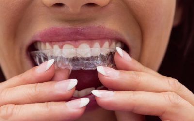 Invisalign Cost: What to Know Before You Start